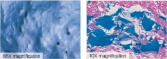 JUVEDERM® VOLLURE® XC 86X and 10X magnification.