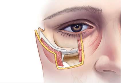 Midface before JUVEDERM® VOLUMA® XC.