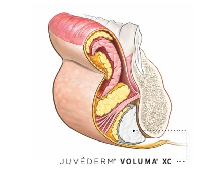 Chin after JUVEDERM® VOLUMA® XC.