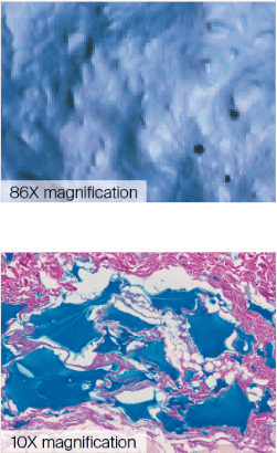 JUVEDERM® VOLLURE® XC 86X and 10X magnification.