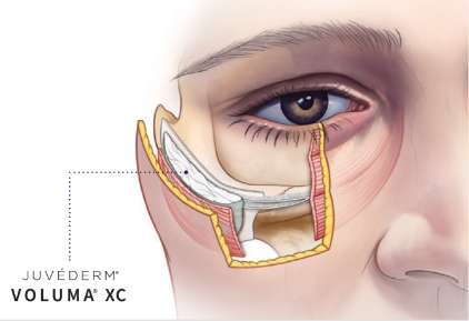 Midface after JUVEDERM® VOLUMA® XC.