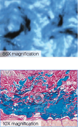 JUVEDERM® ULTRA PLUS XC 86X and 10X magnification.